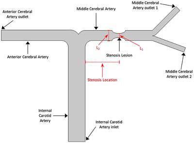 Digital Subtraction Angiography Contrast Material Transport as a Direct Assessment for Blood Perfusion of Middle Cerebral Artery Stenosis